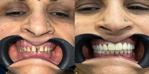 Dental after before