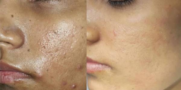 face after before
