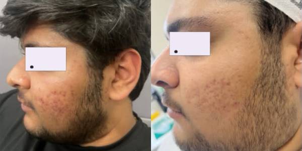 face after before slide 4