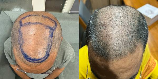 hair after before