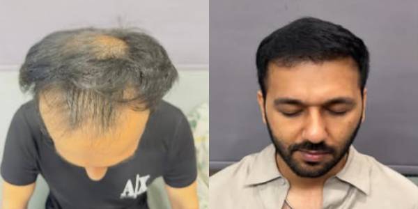 hair after before