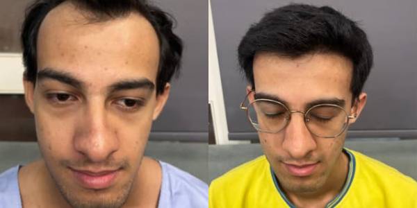 hair after before