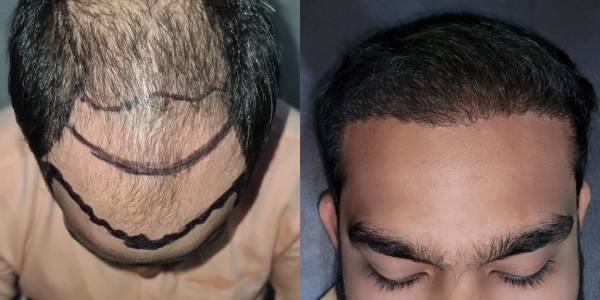 hair after before