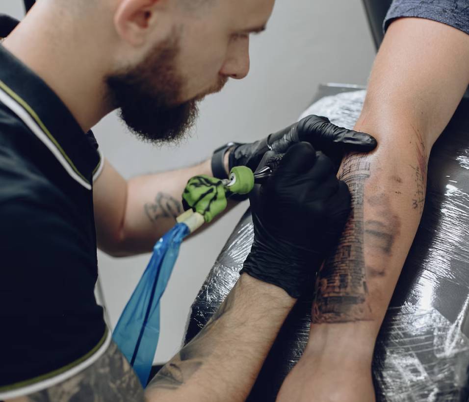 Laser Treatment laser tattoo removal