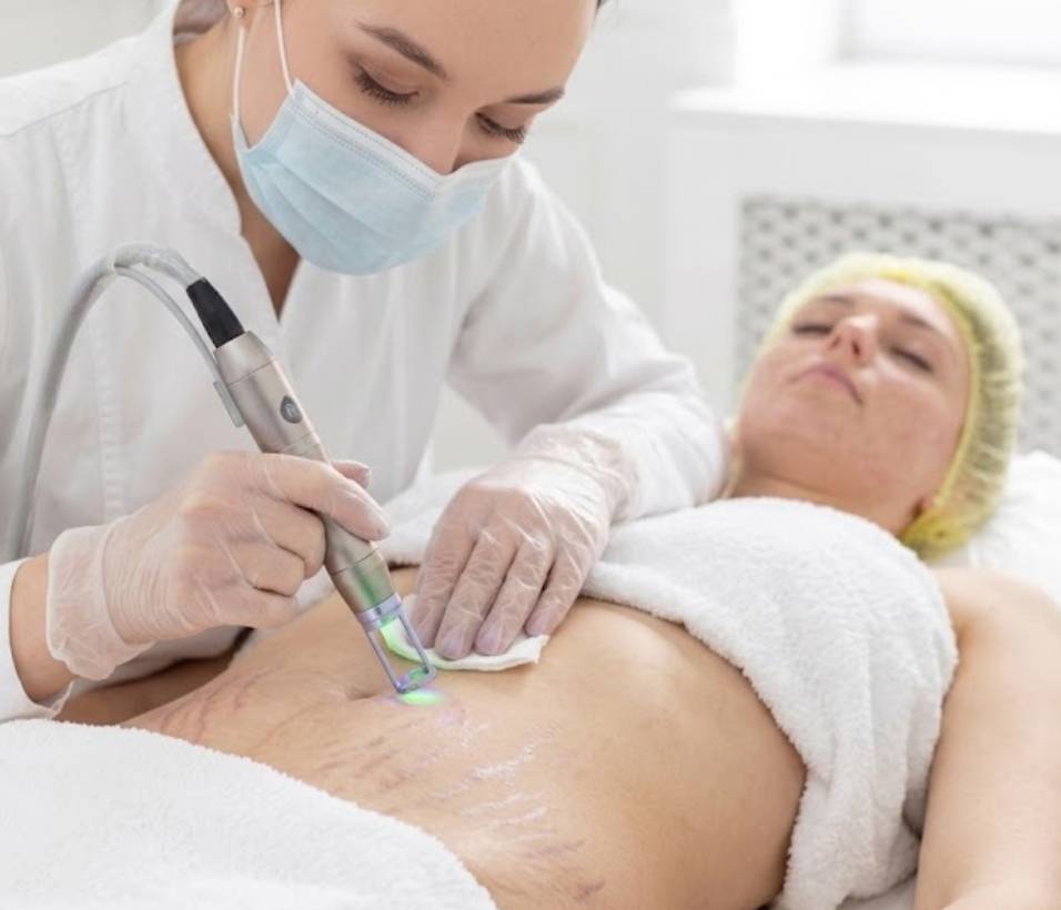 Cosmetic Treatment stretch mark treatment